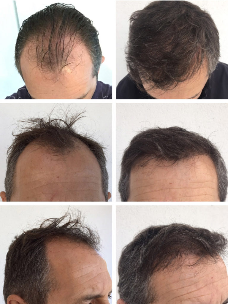 Implant capillaire avant apres FUE