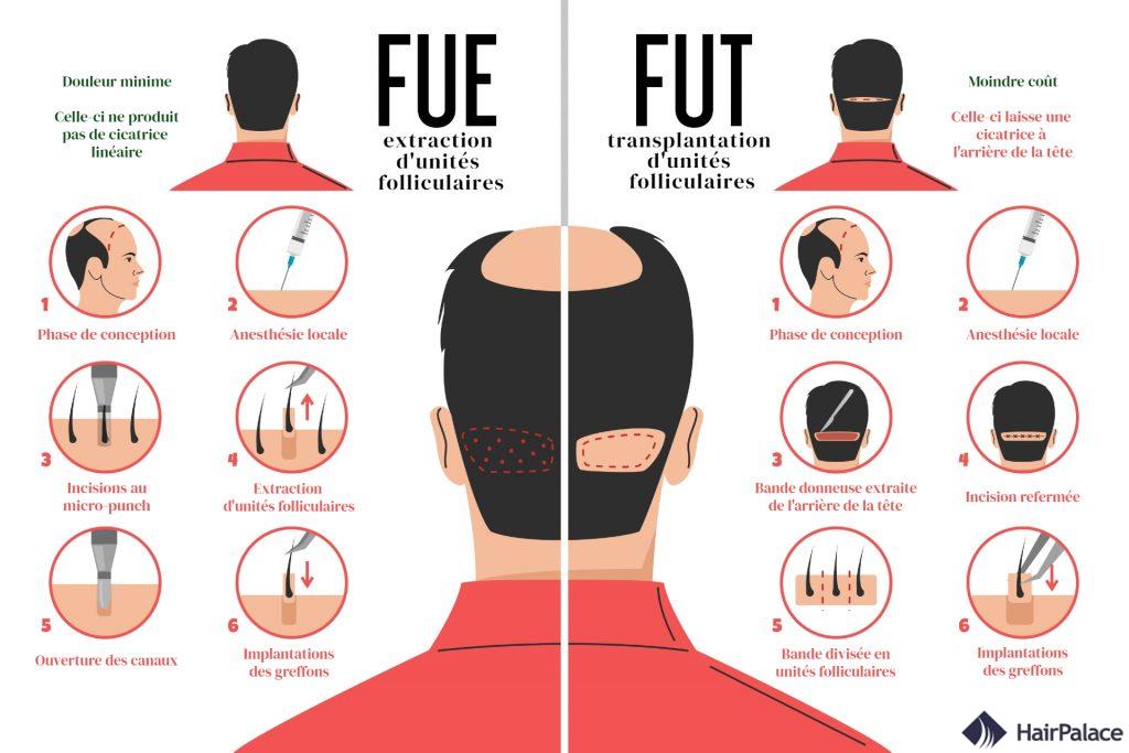 DHI, FUT et FUE : Guide complet des greffes de cheveux