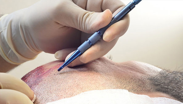 Qu'est que la FUE saphir greffe capillaire ? 